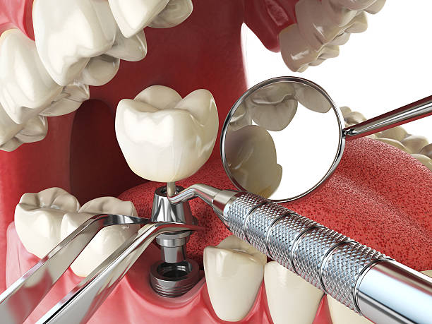 Best Emergency Tooth Extraction in Magnolia Springs, AL
